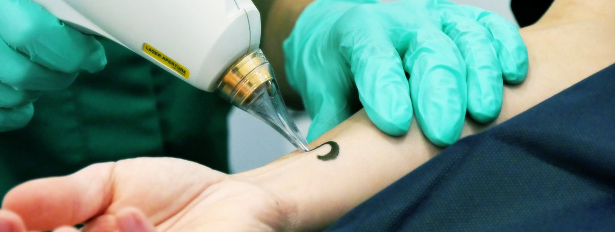 Láser Médico: Eliminación de Tatuajes